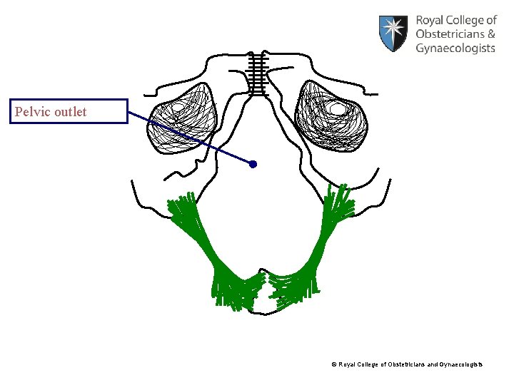 Pelvic outlet © Royal College of Obstetricians and Gynaecologists 
