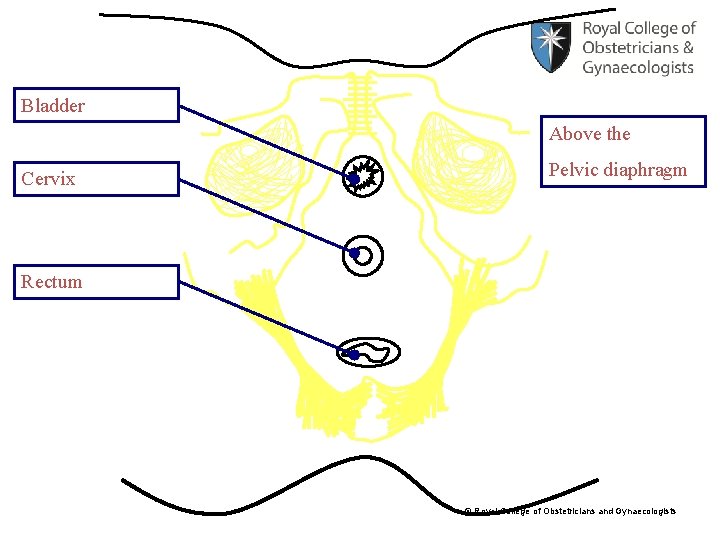 Bladder Above the Cervix Pelvic diaphragm Rectum © Royal College of Obstetricians and Gynaecologists