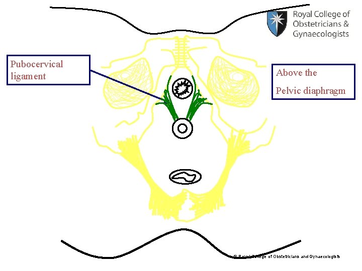 Pubocervical ligament Above the Pelvic diaphragm © Royal College of Obstetricians and Gynaecologists 