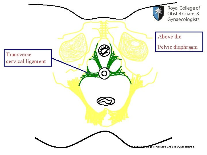 Above the Pelvic diaphragm Transverse cervical ligament © Royal College of Obstetricians and Gynaecologists