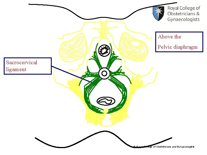 Above the Pelvic diaphragm Sacrocervical ligament © Royal College of Obstetricians and Gynaecologists 