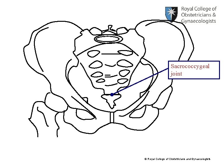 Sacrococcygeal joint © Royal College of Obstetricians and Gynaecologists 