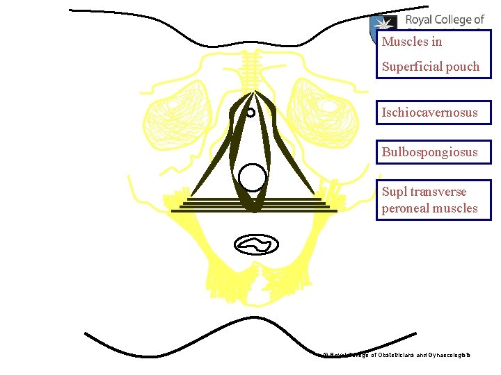Muscles in Superficial pouch Ischiocavernosus Bulbospongiosus Supl transverse peroneal muscles © Royal College of