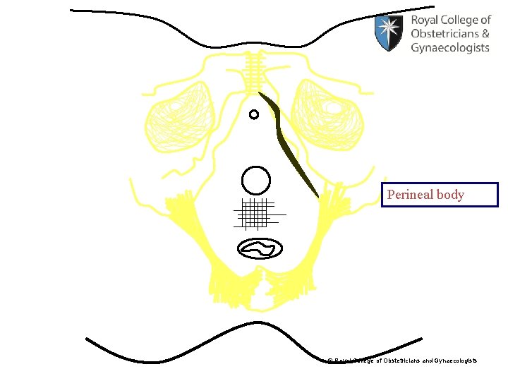 Perineal body © Royal College of Obstetricians and Gynaecologists 