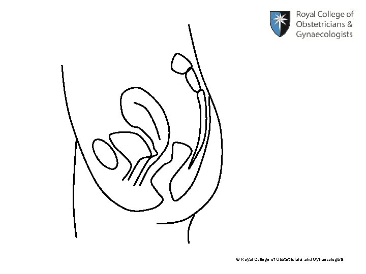 © Royal College of Obstetricians and Gynaecologists 