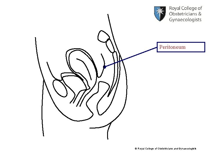 Peritoneum © Royal College of Obstetricians and Gynaecologists 