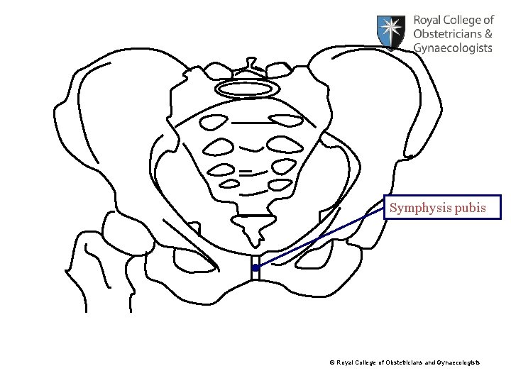 Symphysis pubis © Royal College of Obstetricians and Gynaecologists 