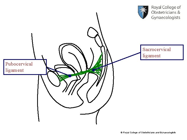 Sacrocervical ligament Pubocervical ligament © Royal College of Obstetricians and Gynaecologists 