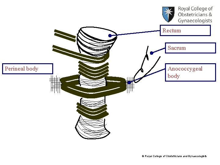 Rectum Sacrum Perineal body Anococcygeal body © Royal College of Obstetricians and Gynaecologists 