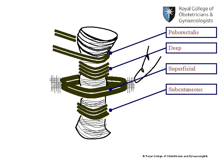 Puborectalis Deep Superficial Subcutaneous © Royal College of Obstetricians and Gynaecologists 