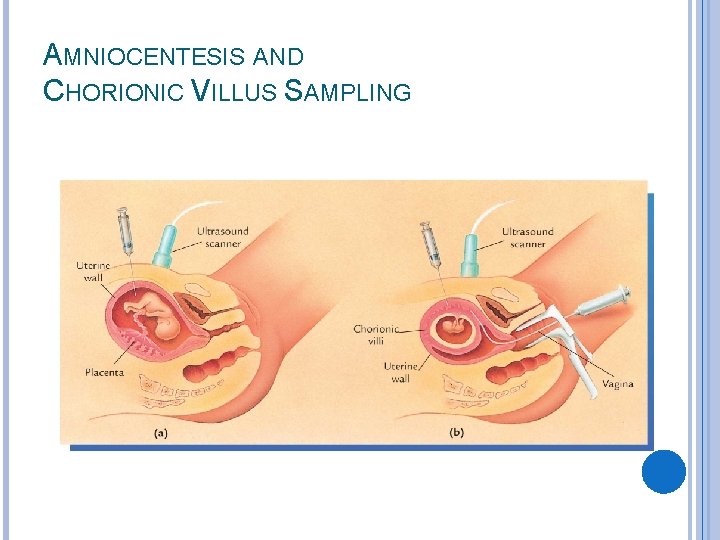 AMNIOCENTESIS AND CHORIONIC VILLUS SAMPLING 