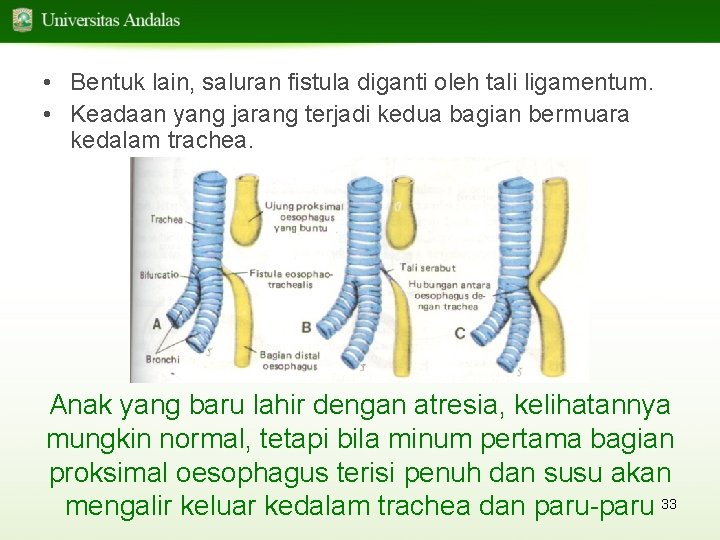  • Bentuk lain, saluran fistula diganti oleh tali ligamentum. • Keadaan yang jarang