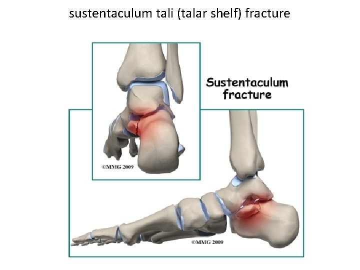 sustentaculum tali (talar shelf) fracture 