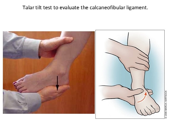 Talar tilt test to evaluate the calcaneofibular ligament. 
