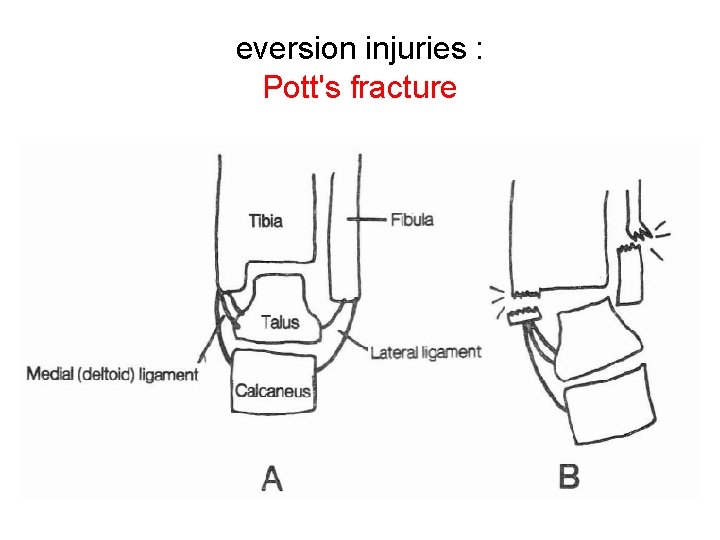 eversion injuries : Pott's fracture 
