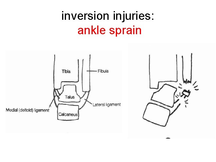 inversion injuries: ankle sprain 