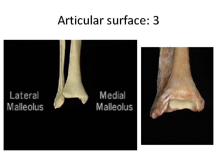 Articular surface: 3 