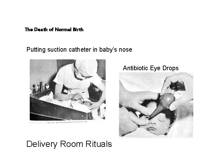 The Death of Normal Birth Putting suction catheter in baby’s nose Antibiotic Eye Drops