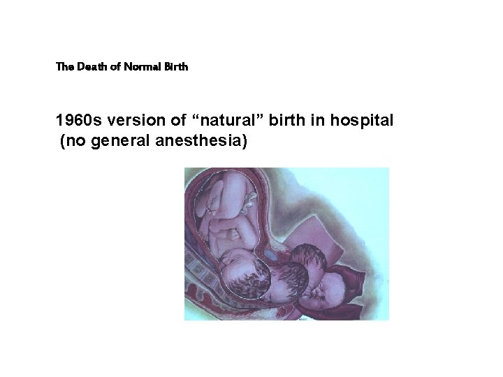 The Death of Normal Birth 1960 s version of “natural” birth in hospital (no