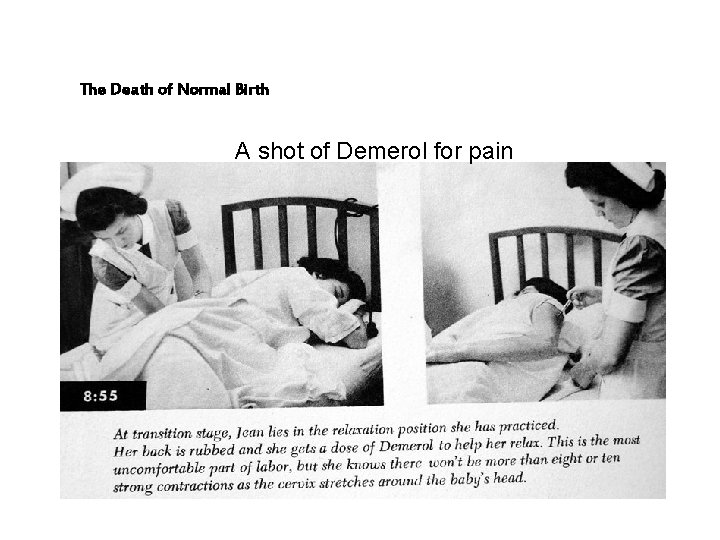 The Death of Normal Birth A shot of Demerol for pain 