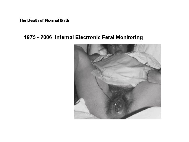 The Death of Normal Birth 1975 - 2006 Internal Electronic Fetal Monitoring 