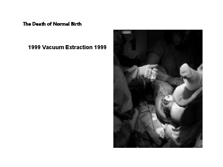The Death of Normal Birth 1999 Vacuum Extraction 1999 