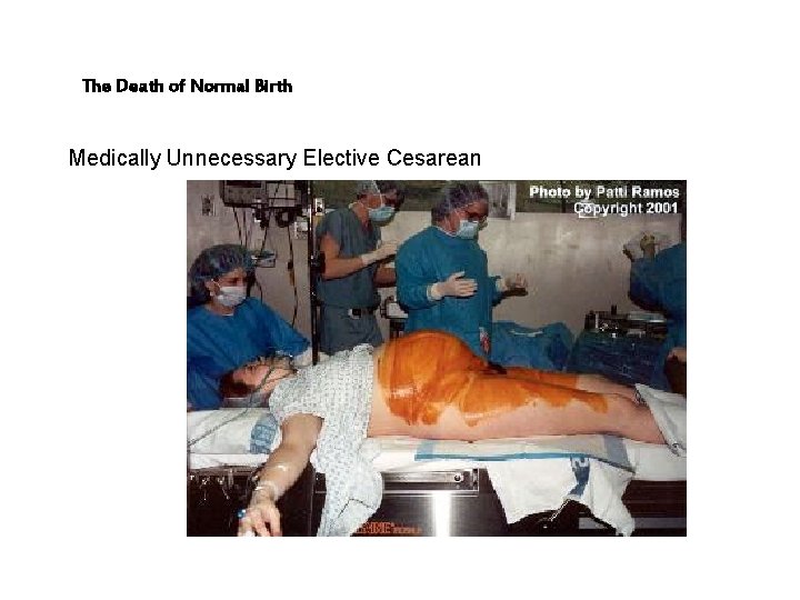 The Death of Normal Birth Medically Unnecessary Elective Cesarean 