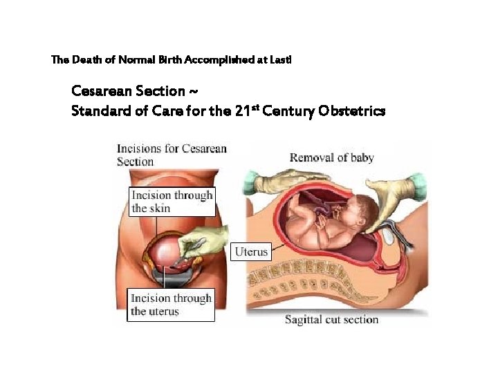 The Death of Normal Birth Accomplished at Last! Cesarean Section ~ Standard of Care