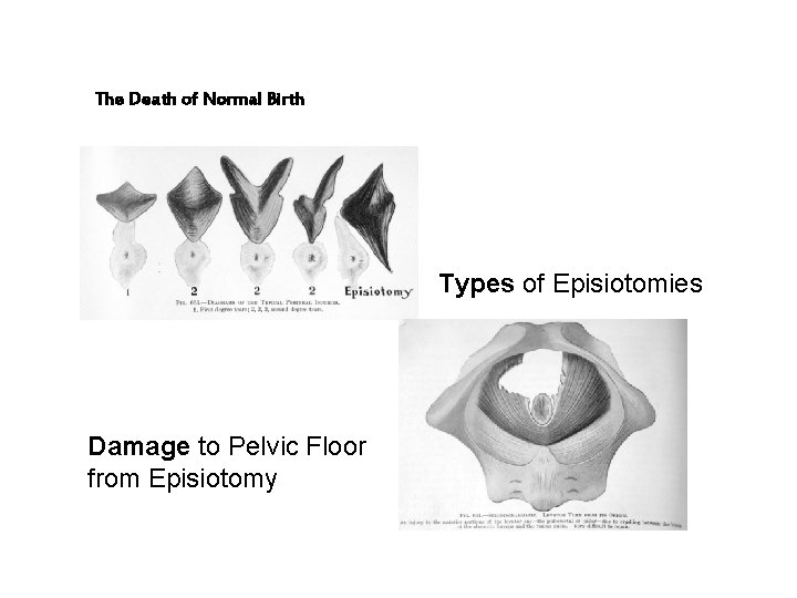 The Death of Normal Birth Types of Episiotomies Damage to Pelvic Floor from Episiotomy