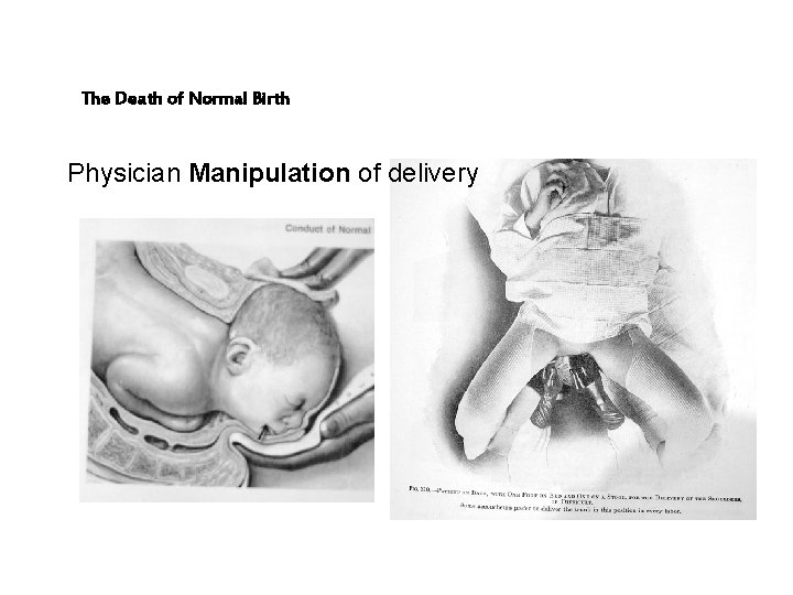 The Death of Normal Birth Physician Manipulation of delivery 