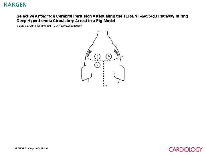 Selective Antegrade Cerebral Perfusion Attenuating the TLR 4/NF-κ B Pathway during Deep Hypothermia Circulatory