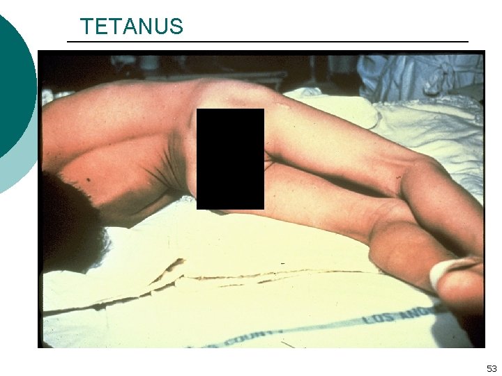 TETANUS 53 