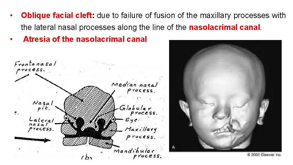 • • Oblique facial cleft: due to failure of fusion of the maxillary • • Oblique facial cleft: due to failure of fusion of the maxillary