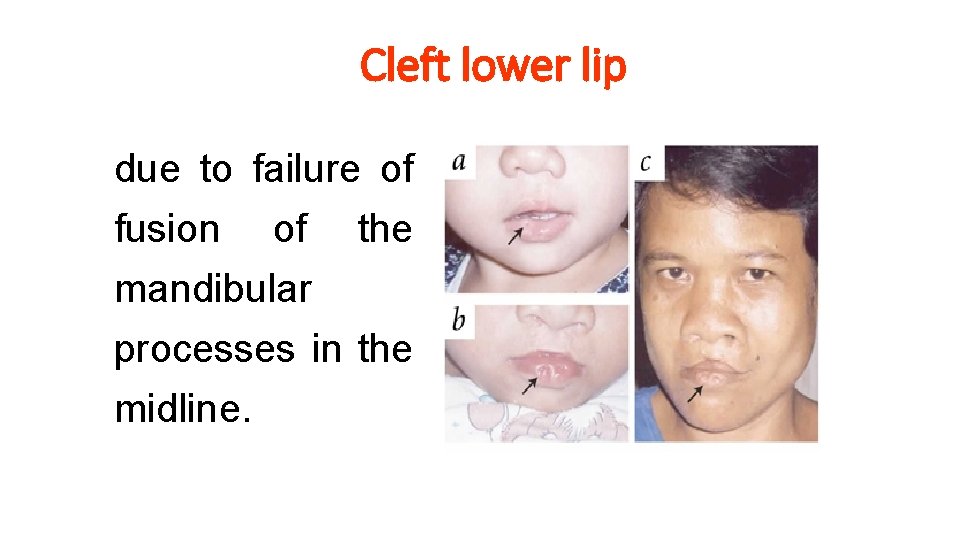 Cleft lower lip due to failure of fusion of the mandibular processes in the Cleft lower lip due to failure of fusion of the mandibular processes in the