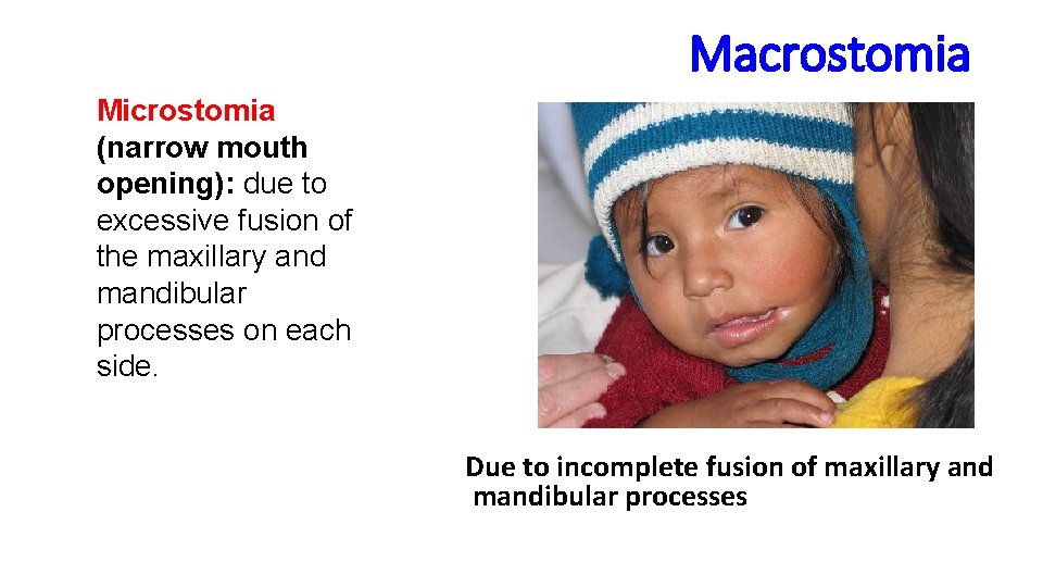 Macrostomia Microstomia (narrow mouth opening): due to excessive fusion of the maxillary and mandibular Macrostomia Microstomia (narrow mouth opening): due to excessive fusion of the maxillary and mandibular