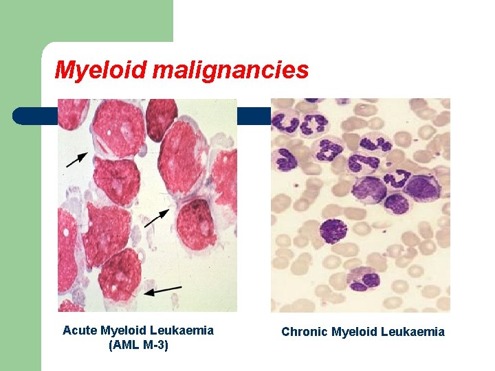 Myeloid malignancies Acute Myeloid Leukaemia (AML M-3) Chronic Myeloid Leukaemia 