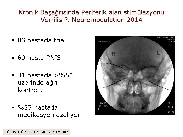 Kronik Başağrısında Periferik alan stimülasyonu Verrilis P. Neuromodulation 2014 § 83 hastada trial §