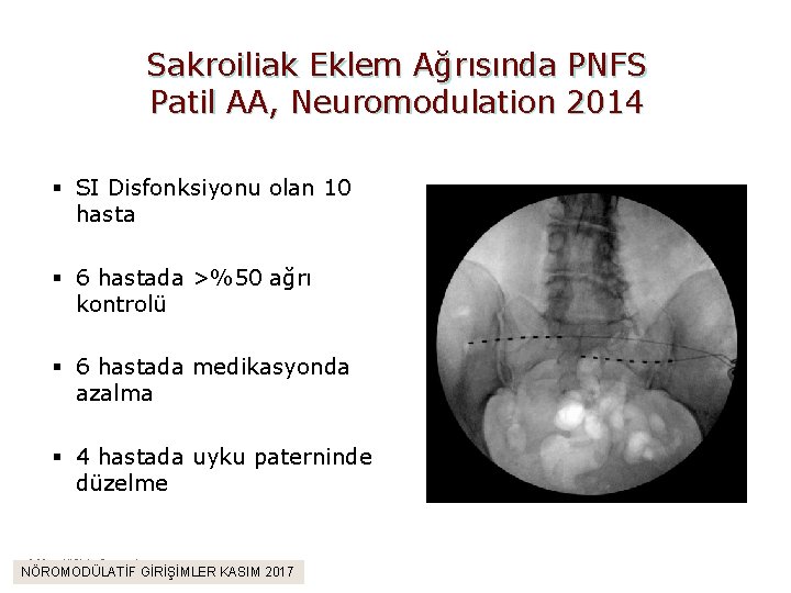 Sakroiliak Eklem Ağrısında PNFS Patil AA, Neuromodulation 2014 § SI Disfonksiyonu olan 10 hasta