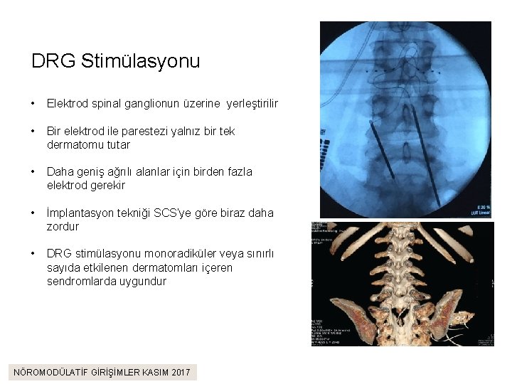 DRG Stimülasyonu • Elektrod spinal ganglionun üzerine yerleştirilir • Bir elektrod ile parestezi yalnız