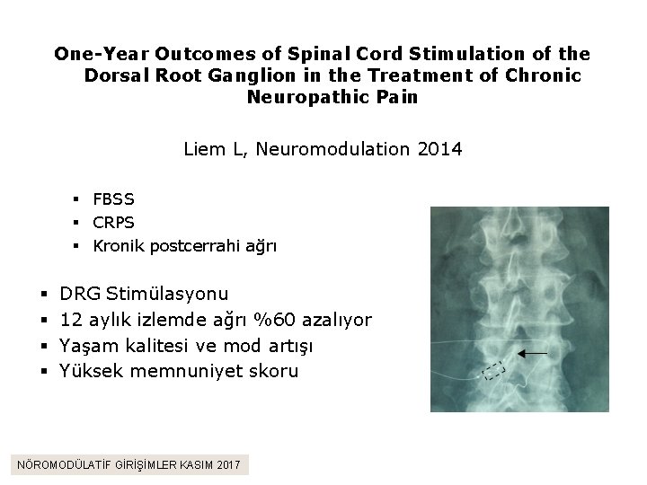 One-Year Outcomes of Spinal Cord Stimulation of the Dorsal Root Ganglion in the Treatment