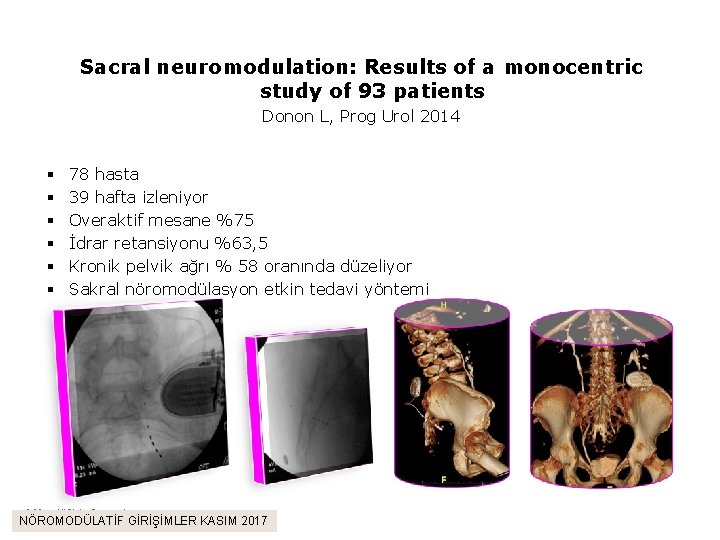 Sacral neuromodulation: Results of a monocentric study of 93 patients Donon L, Prog Urol