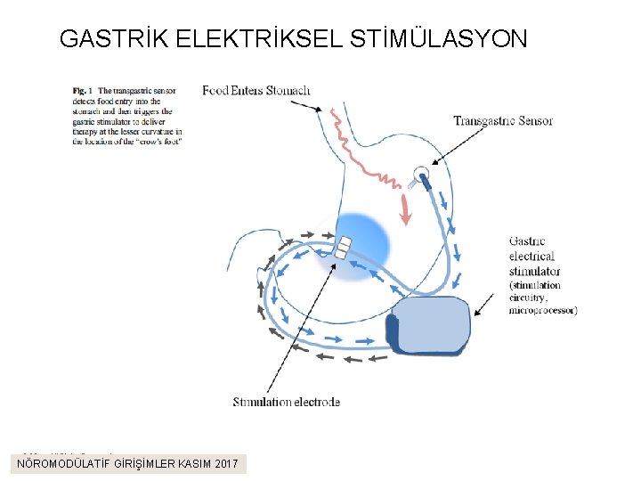 GASTRİK ELEKTRİKSEL STİMÜLASYON © 2011. All Rights Reserved. NÖROMODÜLATİF GİRİŞİMLER KASIM 2017 