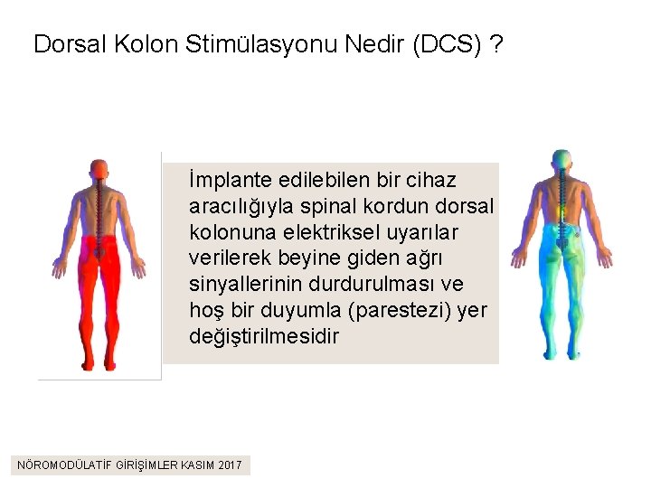 Dorsal Kolon Stimülasyonu Nedir (DCS) ? İmplante edilebilen bir cihaz aracılığıyla spinal kordun dorsal