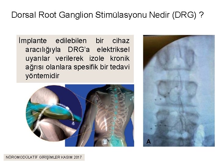 Dorsal Root Ganglion Stimülasyonu Nedir (DRG) ? İmplante edilebilen bir cihaz aracılığıyla DRG’a elektriksel