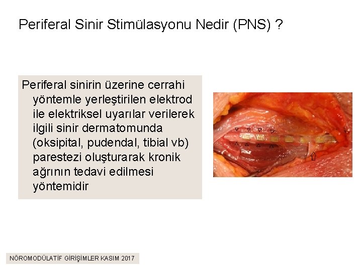 Periferal Sinir Stimülasyonu Nedir (PNS) ? Periferal sinirin üzerine cerrahi yöntemle yerleştirilen elektrod ile