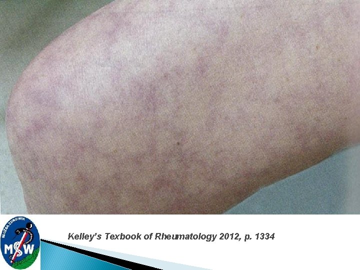 Kelley’s Texbook of Rheumatology 2012, p. 1334 