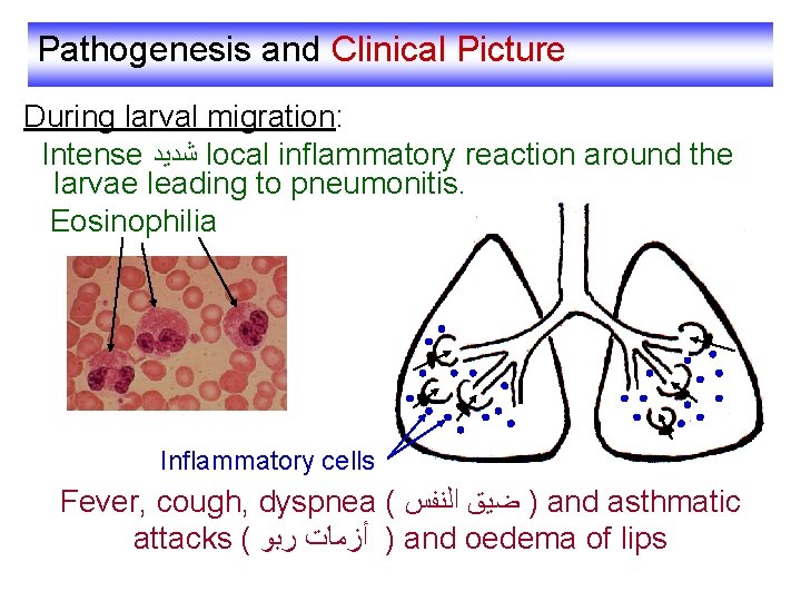 Pathogenesis and Clinical Picture During larval migration: Intense ﺷﺪﻳﺪ local inflammatory reaction around the