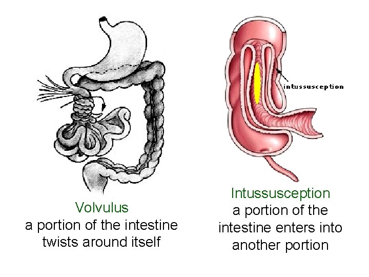 Volvulus a portion of the intestine twists around itself Intussusception a portion of the