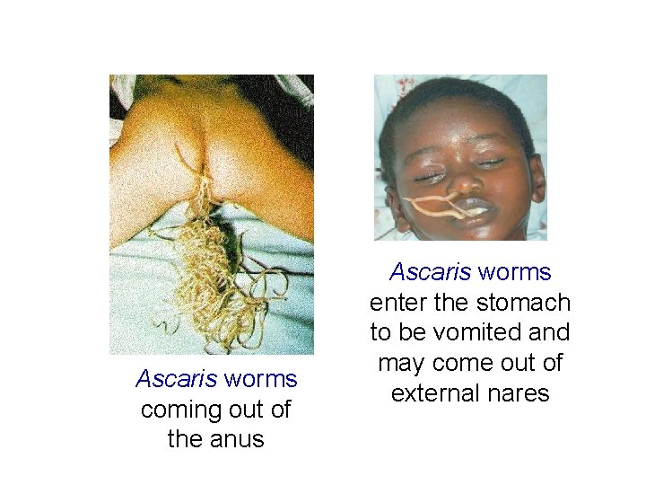 Ascaris worms coming out of the anus Ascaris worms enter the stomach to be