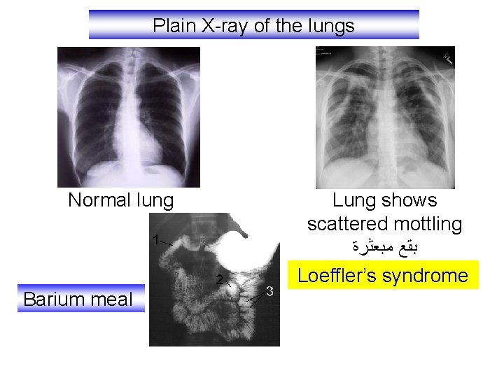 Plain X-ray of the lungs Normal lung Barium meal Lung shows scattered mottling ﺑﻘﻊ